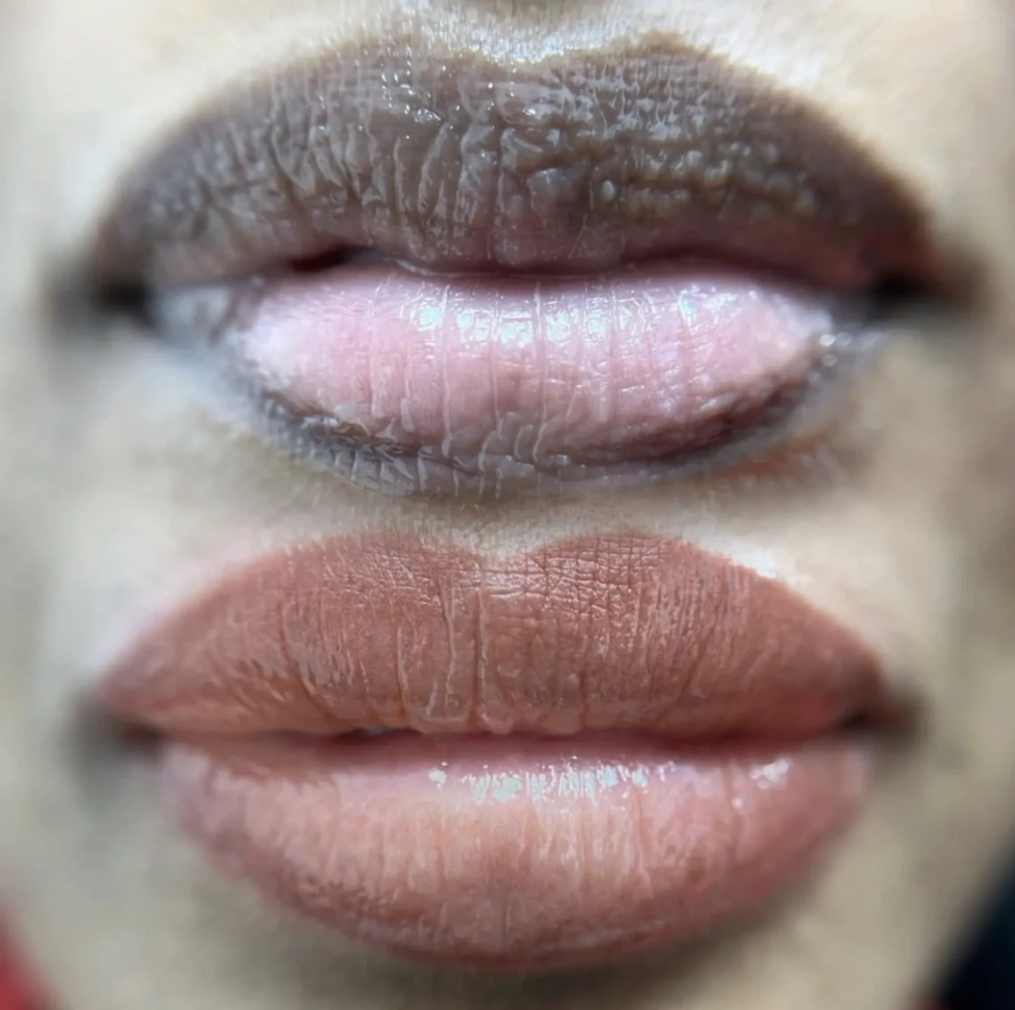 Is Smoking Safe After Lip Neutralisation?