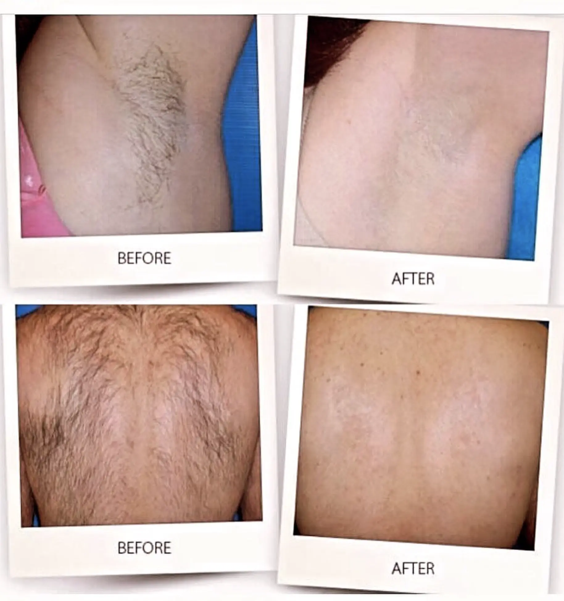 does ipl remove hair